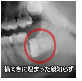 埋伏歯抜歯